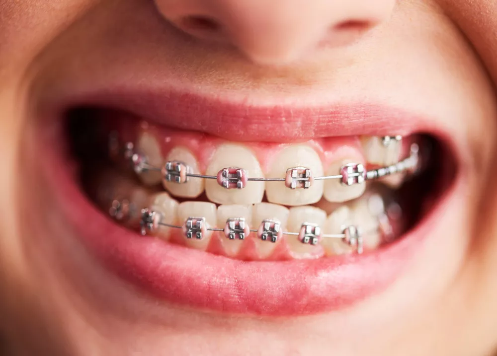 Teeth Braces Price in Lahore