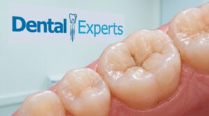 Deep molar grooves that are a common mechanical cause of decay