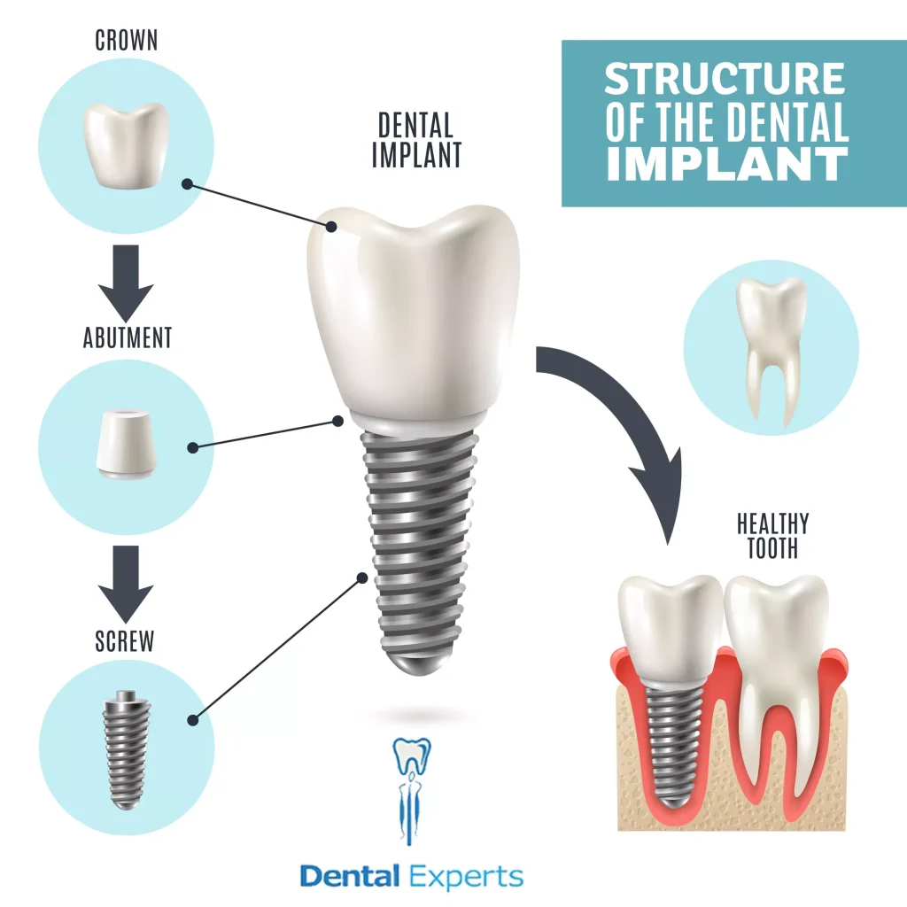 Dental Implant in Lahore