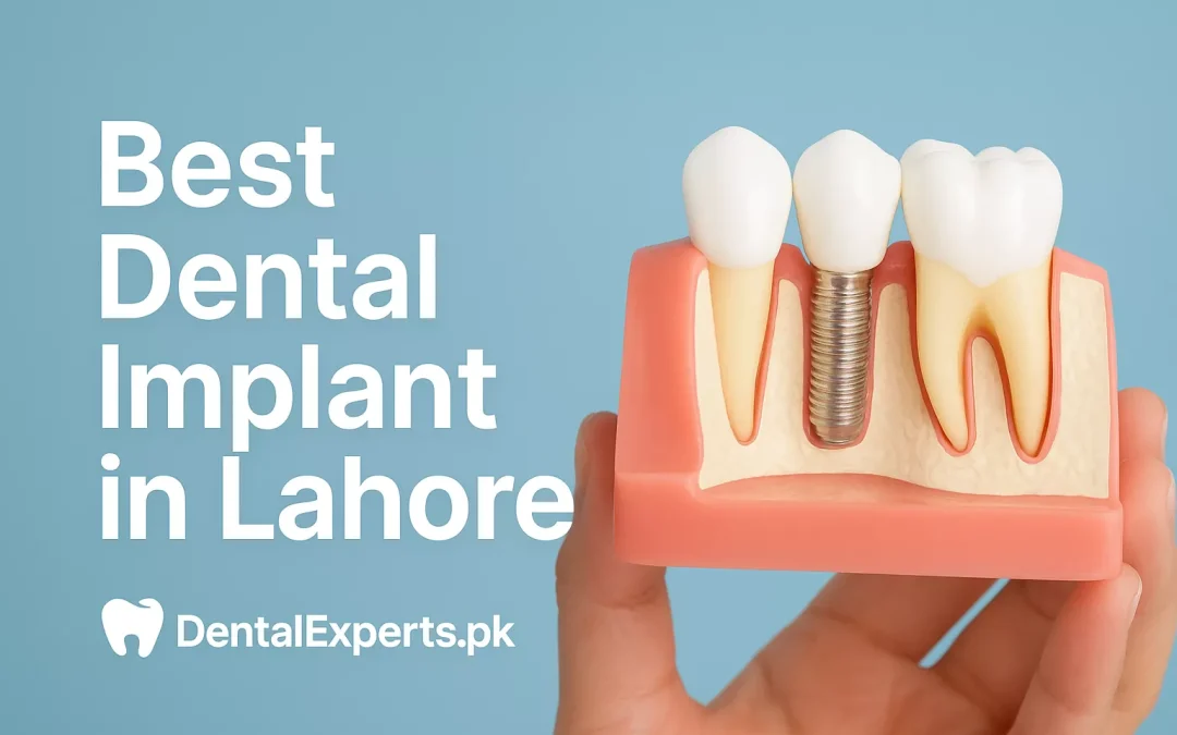 Affordable & Reliable: Finding the Best Dental Implant in Lahore