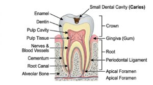 Illustration showing a cavity forming in tooth enamel