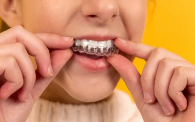 Types of Retainers After Braces – Benefits And Cost