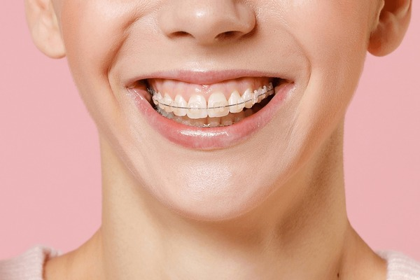 Affordable Teeth Braces Price in Lahore: Metal, Ceramic & Invisible Braces
