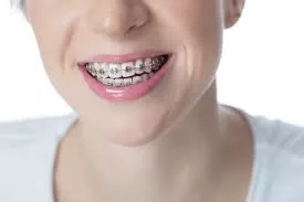 Teeth Braces Price in Lahore: Why Prices Vary Between Clinics