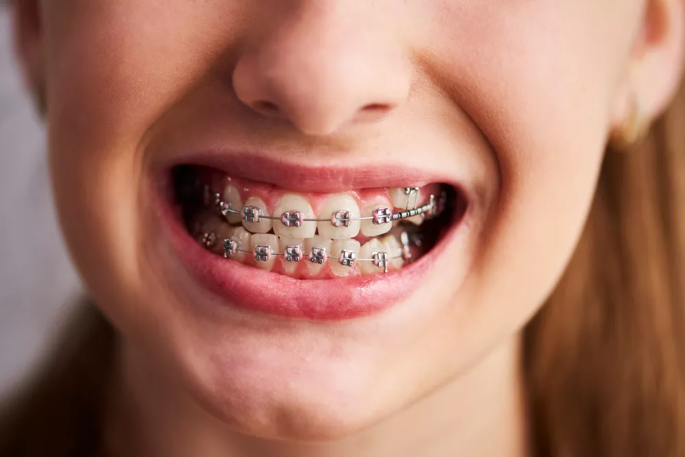 Teeth Braces Price in Lahore
