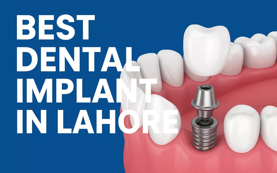 best dental implant in lahore
