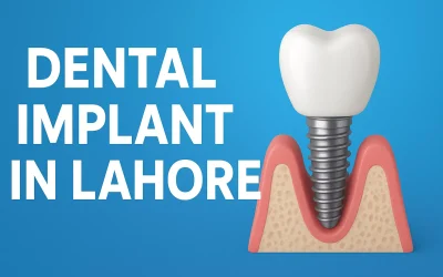 Step-by-Step Guide to Getting the Best Dental Implant in Lahore