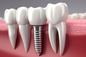 dental implant cost in Pakistan