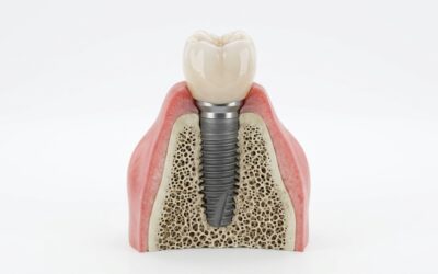 How Long Do Dental Implants Last?