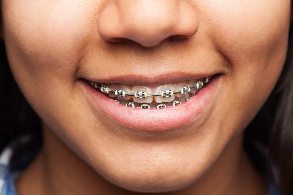 Metal Braces Price in Pakistan Explained: Affordable Options for Every Smile