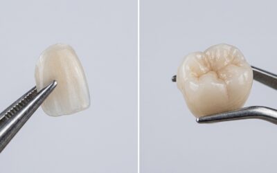 Veneers vs Crowns: Which Is Right for You?